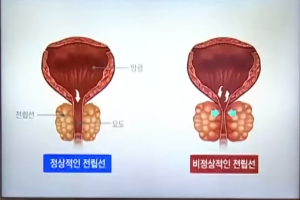전립선